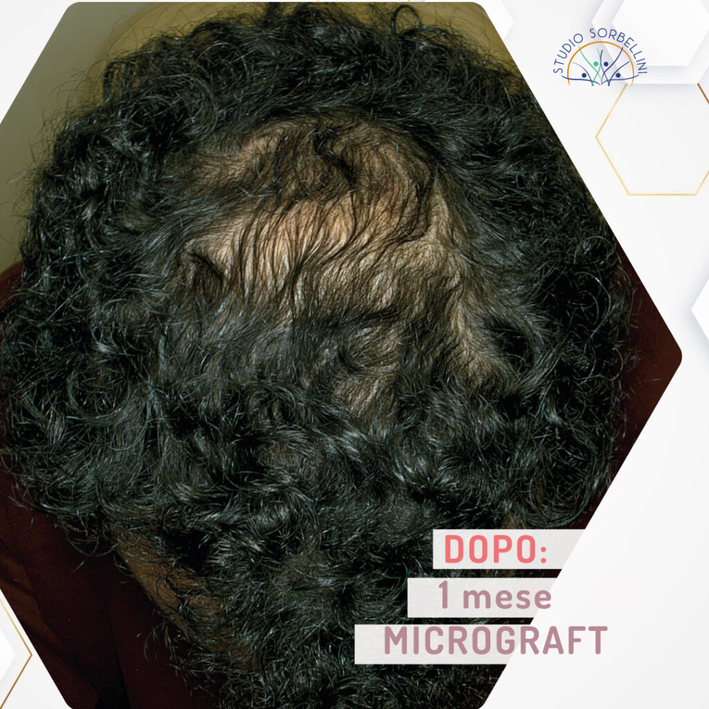 Dopo-MICROGRAFT-frontale-1-mese