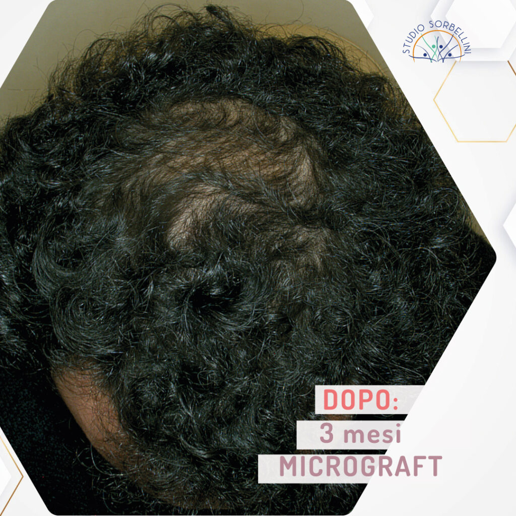 Dopo-MICROGRAFT-frontale-3-mesi