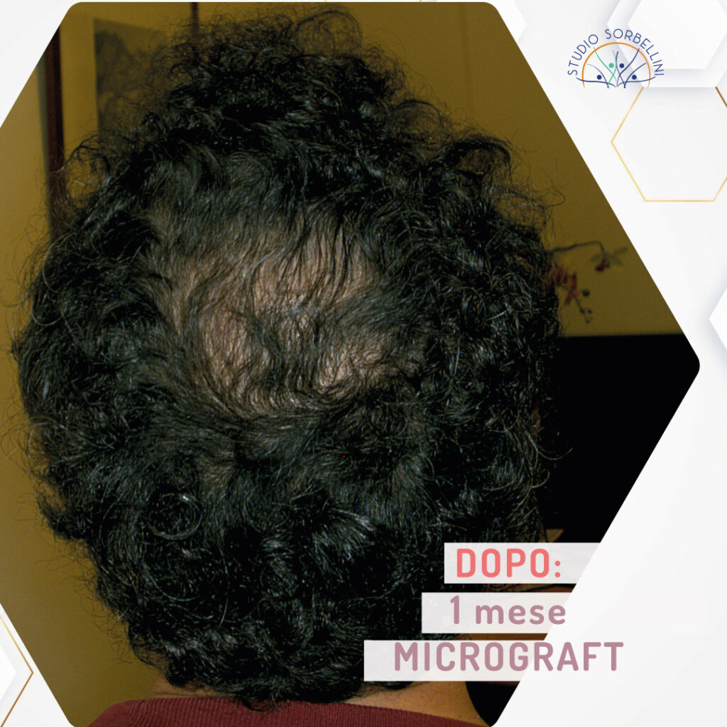 Dopo-MICROGRAFT-occipitale-1-mese