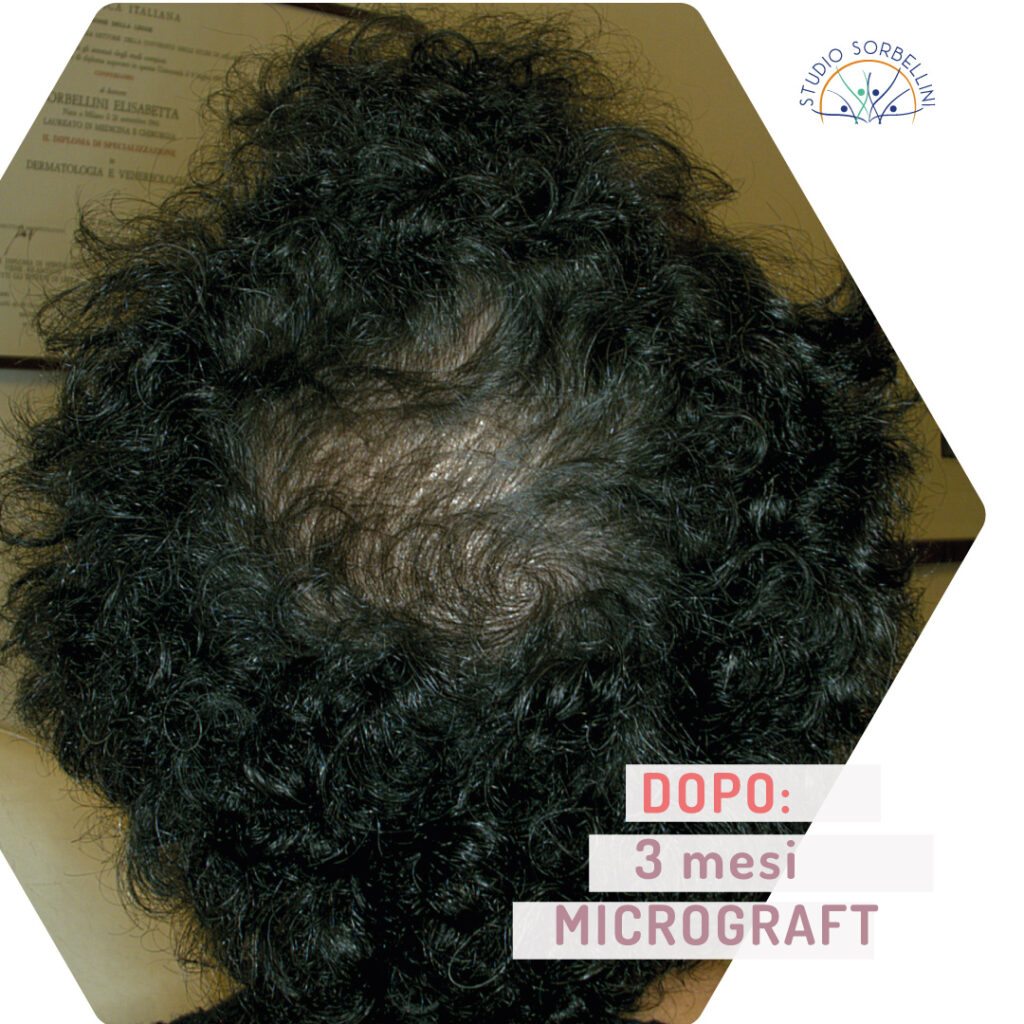 Dopo-MICROGRAFT-occipitale-3-mesi