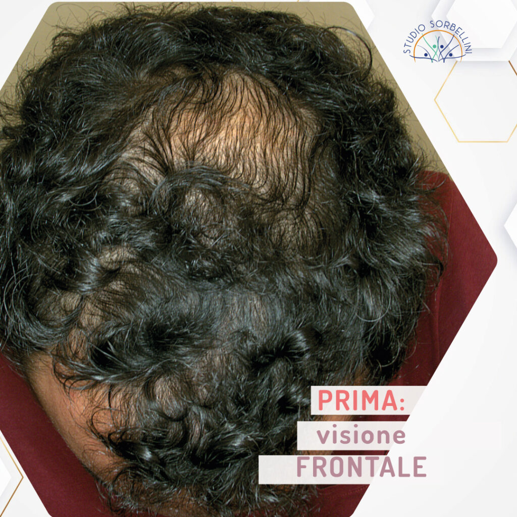 Prima-MICROGRAFT-frontale