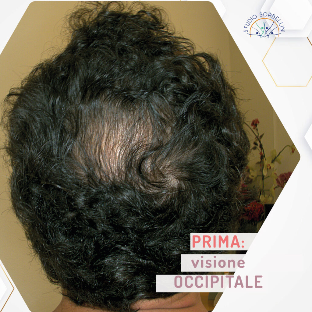 Prima-MICROGRAFT-occipitale