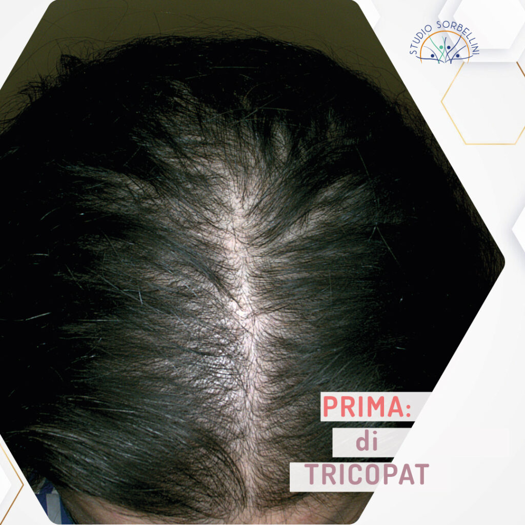 Prima-TRICOPAT_Donna-1