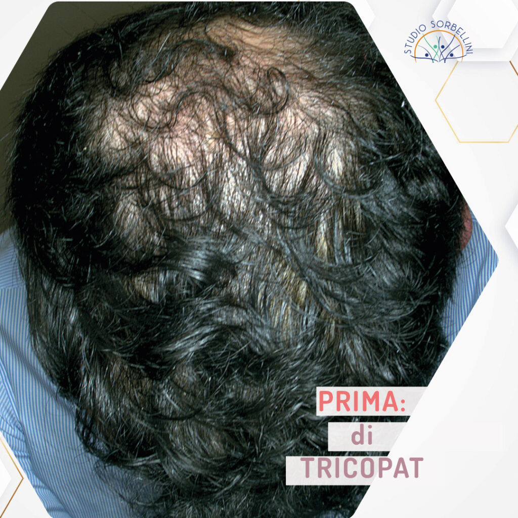 Prima-TRICOPAT_Uomo-1