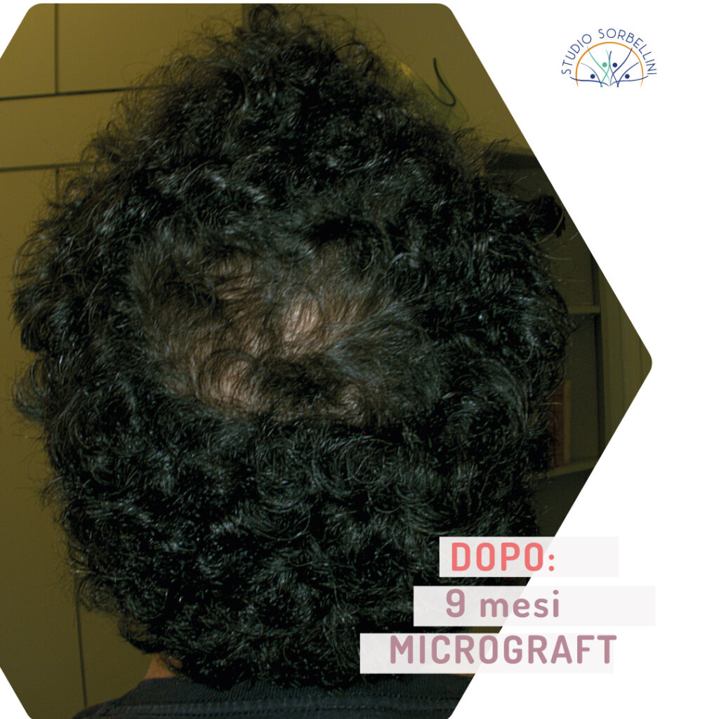 Prima-e-dopo-MICROGRAFT-9mesi-back