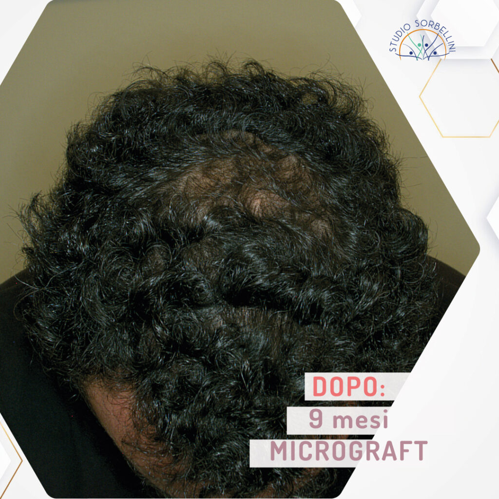 Prima-e-dopo-MICROGRAFT-9mesi-top